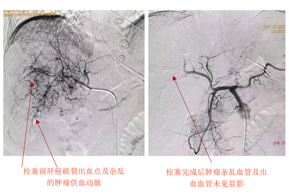 肝癌破裂大出血命悬一线——西北大学第一医院急诊介入止血化险为夷